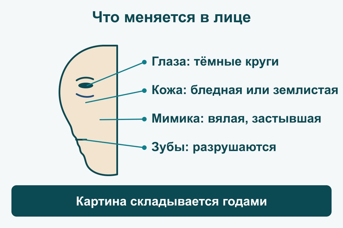 Схема: контур лица в профиль с выносками — глаза (тёмные круги), кожа (бледная или землистая), мимика (вялая), зубы (разрушаются)