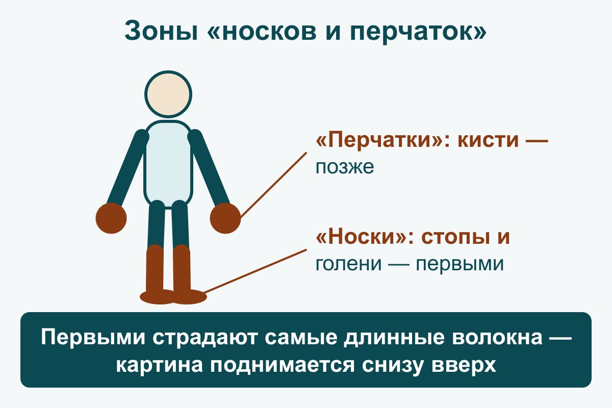 Схема «носки и перчатки»: контур человека, зоны нарушенной чувствительности закрашены на стопах и голенях (первыми) и на кистях (позже)